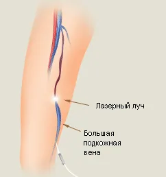 Лазерно лечение на разширени вени