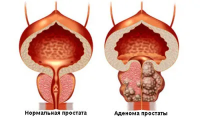 Tratamentul HBP pentru bărbați ceea ce este hiperplazia benignă de prostată