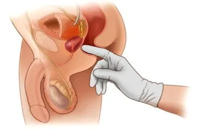 Tratamentul HBP pentru bărbați ceea ce este hiperplazia benignă de prostată