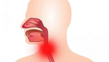 Simptome Laringofaringealny reflux și tratament