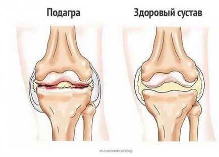 Подагра лечение с йод и аспирин рецепти, здравни тайни