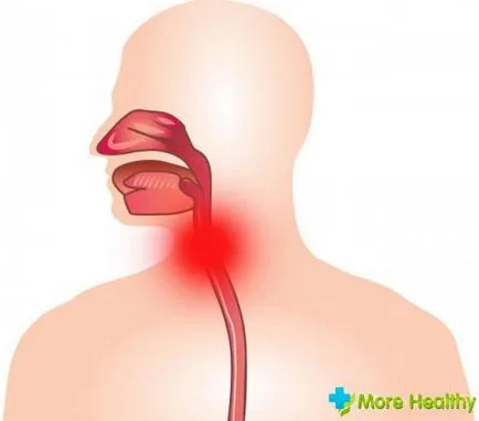 Laringofaringealny simptome de tratament pe termen de reflux