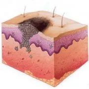 Kezelése bazális sejtes karcinóma, a bőr eltávolítása lézeres