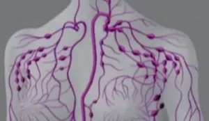 Hodgkin limfom nodular scleroza, onkostatus