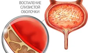 цистит лечение народни средства, различни методи