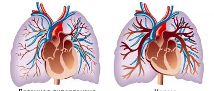 Hipertensiunea pulmonară la copii prognostic, tratament