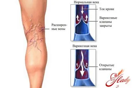 Лечение на разширени вени мед