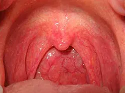 Faringita - cauze, simptome, diagnostic și tratament