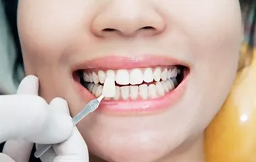 Restaurare estetică de dinți frontali - metodele, materialele utilizate, efectul