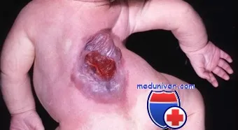 Mielomeningocel (meningomyelocoele) - tablou clinic, diagnostic, tratament