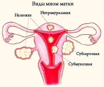 Fibrom uterin dimensiuni mai mari, care fac, tratamentul