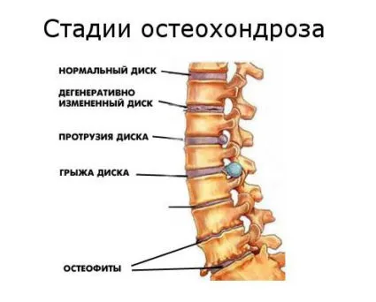 Миелопатия шийните прешлени симптоми, класификация и лечение