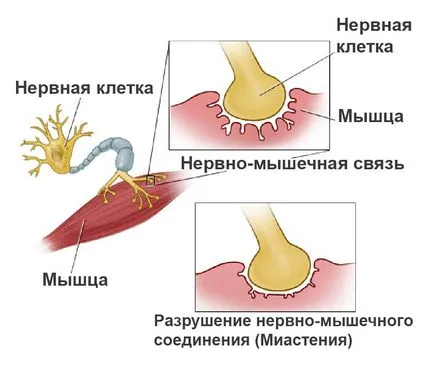 Миастения гравис - какво е това, симптоми и лечение на това заболяване