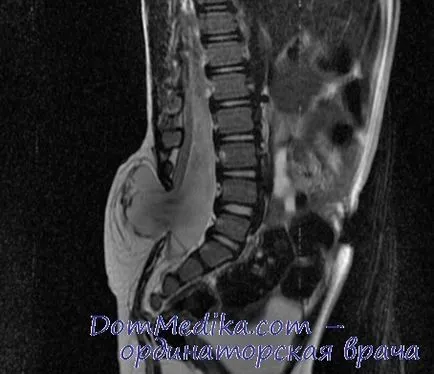 Mielomeningocel (meningomyelocoele) - tablou clinic, diagnostic, tratament