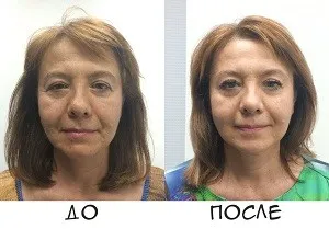 Modelarea unui masaj facial - descriere a tehnologiei