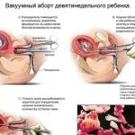 Започва да пие вода от бъбреците боли боли бъбрека какво да прави и как да се отнасяме, бъркотия и хаос