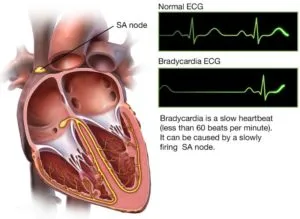 Este posibil să se facă anestezie generală pentru boli de inima