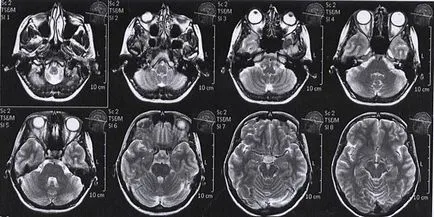 MRI снимки на мозъка, гръбначния стълб, коленна става - моят живот