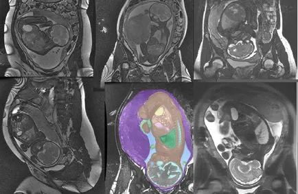 MRI по време на бременност (в ранните етапи), можем да направим