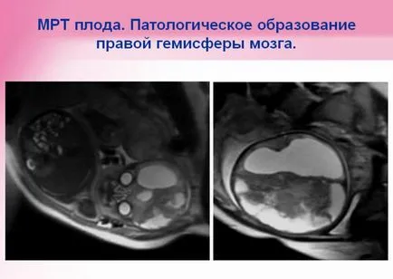 RMN în timpul sarcinii (în stadii incipiente), putem face