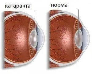 Незрялото лечение на катаракта, независимо дали е необходима операция