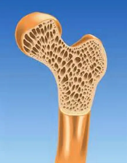 Osteogenesis imperfecta 1