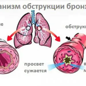 Obstruktív bronchitis felnőtteknél, tünetek, kezelés