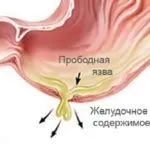 Гастрит нервоза (депресия като причина за гастрит)