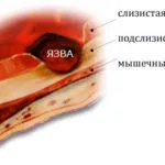 Гастрит нервоза (депресия като причина за гастрит)