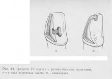 Оперативна техника за получаване на кариозни зъби кухини, превантивна стоматология