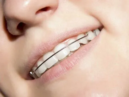 Braces a fogak korrigálására harapás