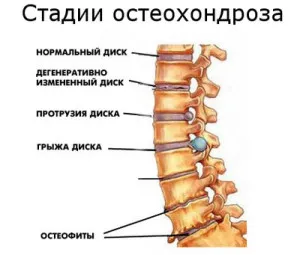 Остеохондроза на шийните прешлени pozvonochika - причини, симптоми и лечение