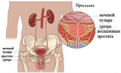 Din ceea ce se produce prostatita - Sănătate de prostată