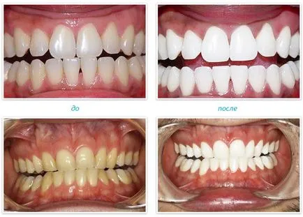 избелване на зъбите увеличение - процедура, избелване технология - д-р зъб