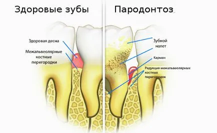 semne și simptome de boala parodontala