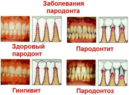 A fogágybetegség jelei és tünetei