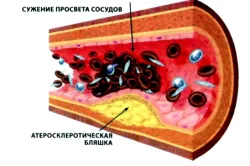 Primele semne de accident vascular cerebral simptome, tratament (foto și video)