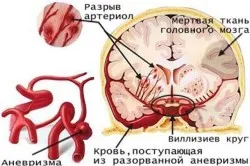 Primele semne de accident vascular cerebral simptome, tratament (foto și video)