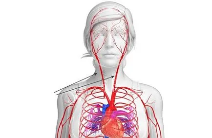 Патологична усуканост вертебрални артерии (деформиране) симптоми, лечение