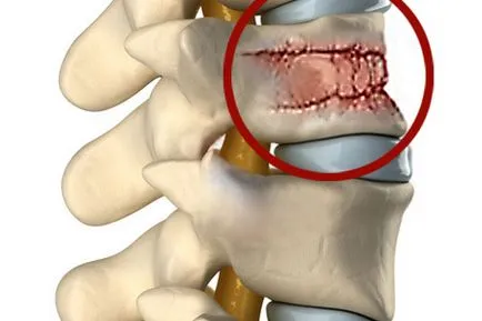 fracturi patologice ale coloanei vertebrale, rupta-compresie tratament fractură fără complicații