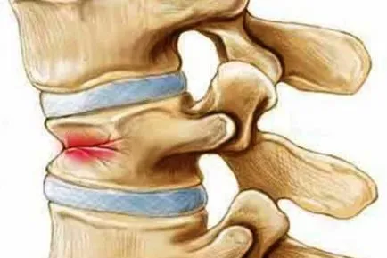 fracturi patologice ale coloanei vertebrale, rupta-compresie tratament fractură fără complicații