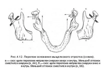 Фрактура на Кондилът