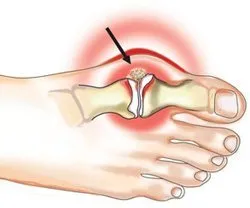 Подагра симптоми и лечение у дома
