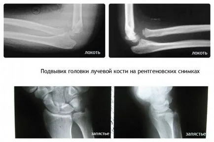 Miért subluxation radiális fej az úgynevezett „zavar a kéz”, függetlenül attól, hogy veszélyes állapot