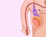 Последици варикоцеле преди и след операция