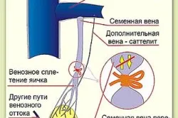 След операцията на варикоцеле