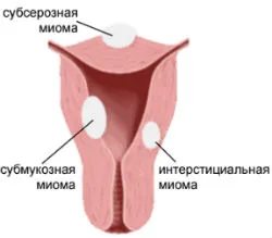 Правилната обработка на маточни фиброиди подсерозни