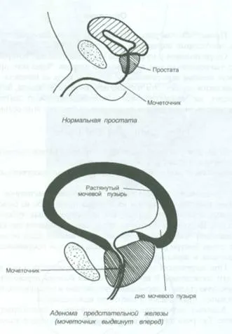 Cerere de acupunctura tratament al bolilor de prostată