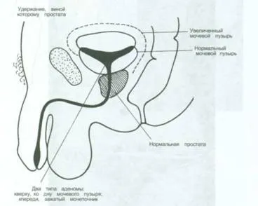 Cerere de acupunctura tratament al bolilor de prostată