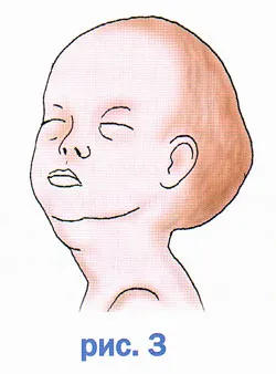 глава новороденото, формата на плода главата, cephalohematoma